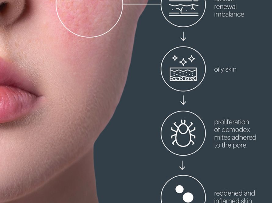 Chemical Peels