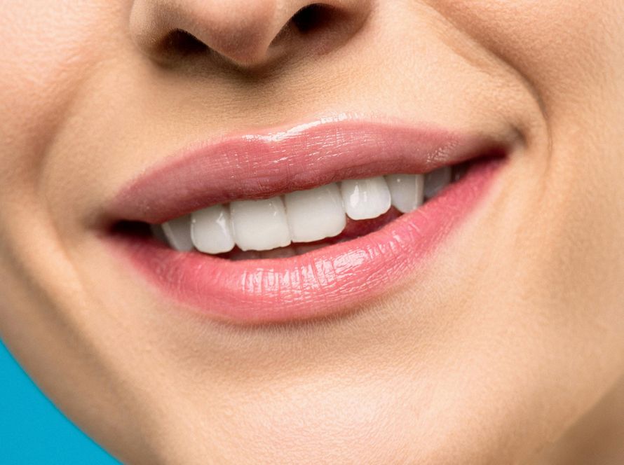 Gummy Smile