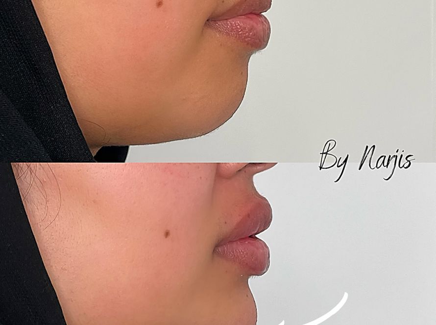 Jaw & Chin Filler