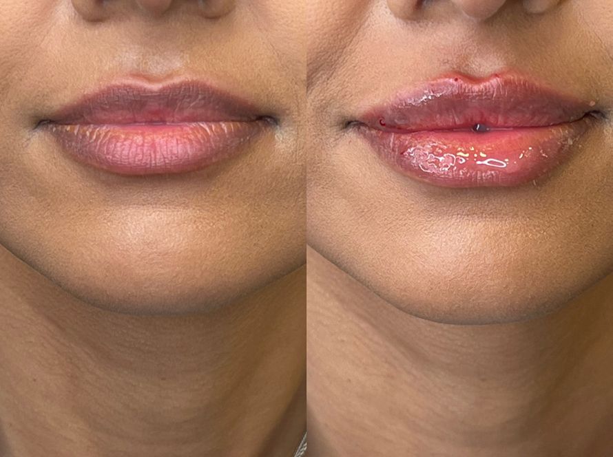Lip Enhancement