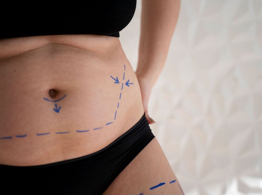 Liposuction at By Narjis