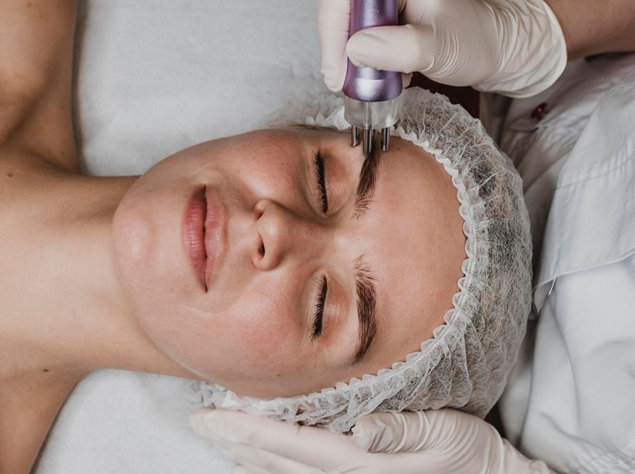Micro-Needling at By Narjis