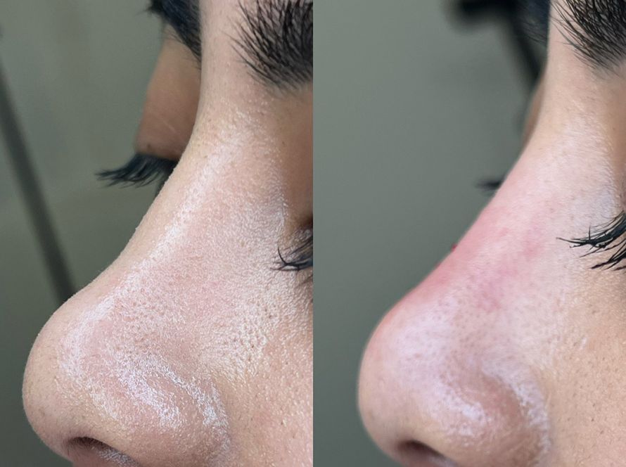Nose Filler Package