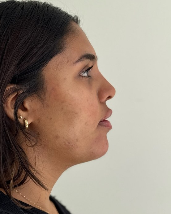 Chin & jawline, case 1 of 8: after