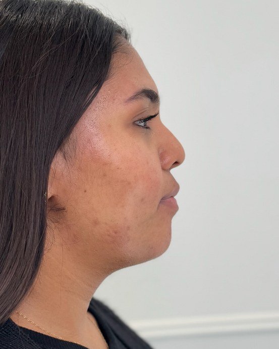 Chin & jawline, case 1 of 8: before