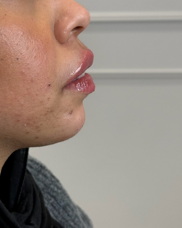 Chin & jawline, case 2 of 8: after