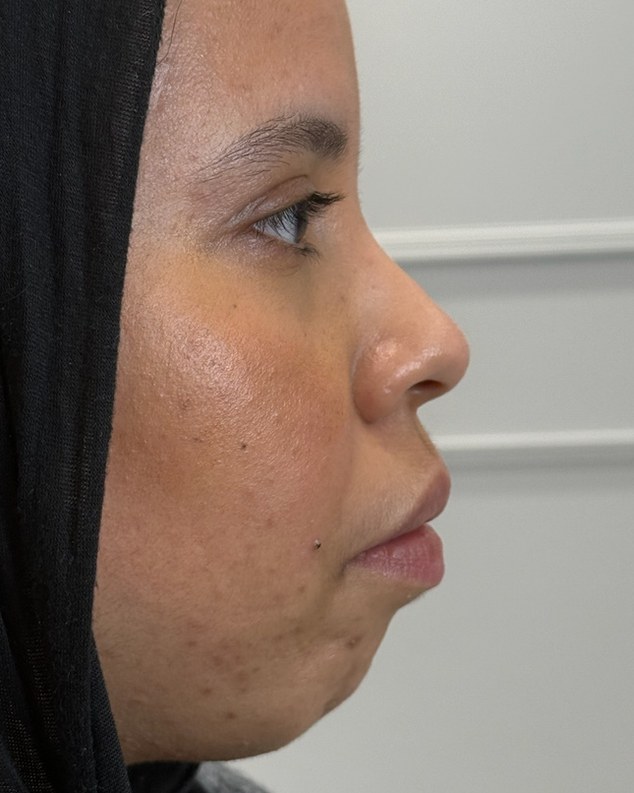 Chin & jawline, case 2 of 8: before