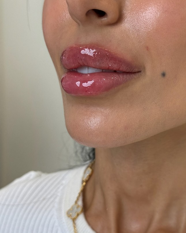 Chin & jawline, case 3 of 8: after