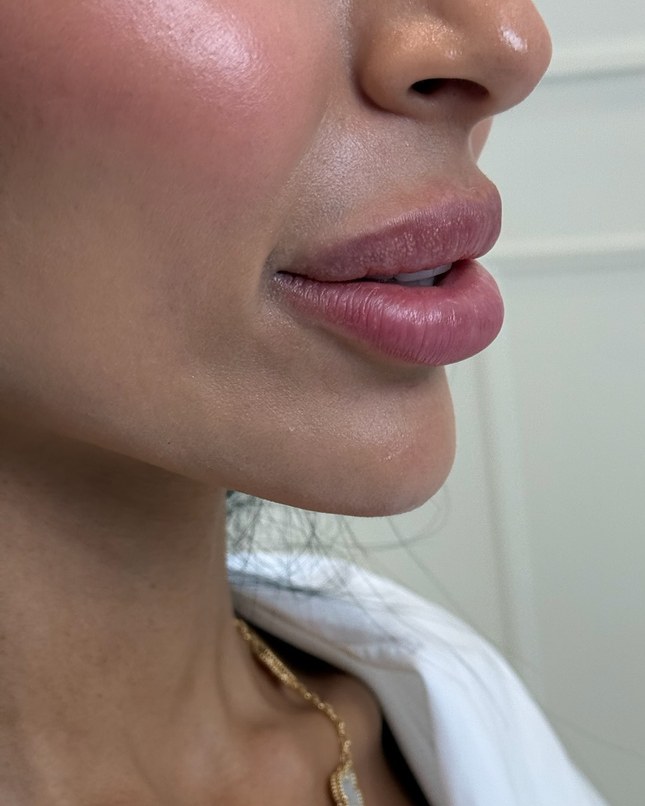 Chin & jawline, case 3 of 8: before