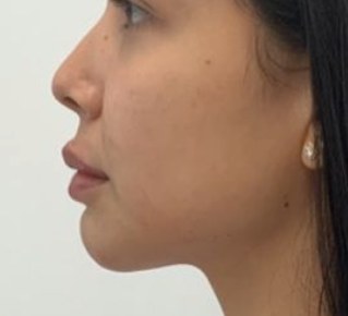 Chin & jawline, case 4 of 8: after