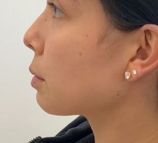 Chin & jawline, case 4 of 8: before