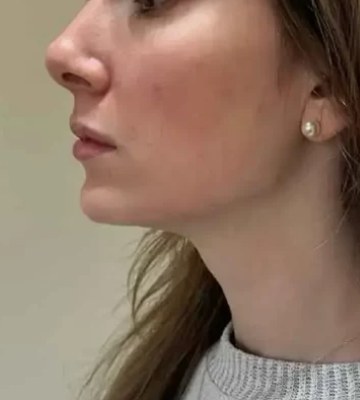 Chin & jawline, case 5 of 8: after