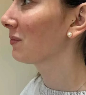 Chin & jawline, case 5 of 8: before