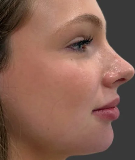 Chin & jawline, case 6 of 8: after