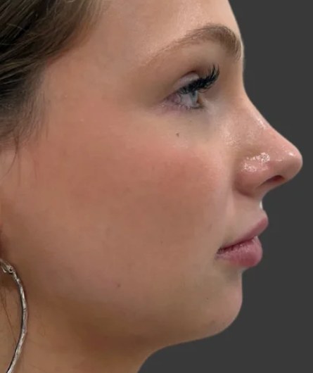 Chin & jawline, case 6 of 8: before