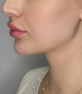 Chin & jawline, case 7 of 8: after
