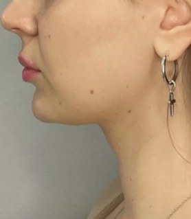 Chin & jawline, case 7 of 8: before