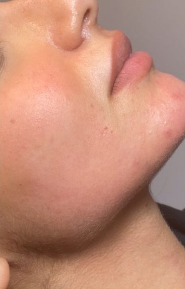 Chin & jawline, case 8 of 8: after