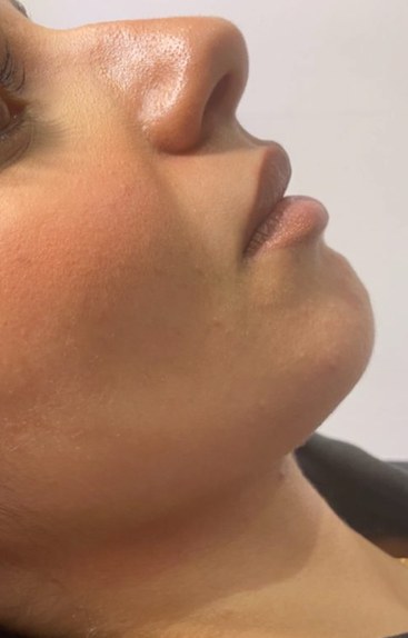 Chin & jawline, case 8 of 8: before