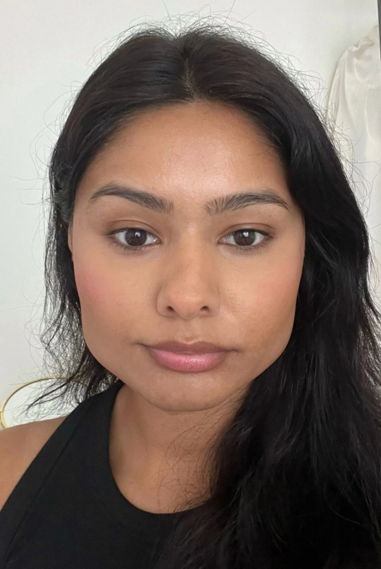 Jaw reduction, case 2 of 3: before