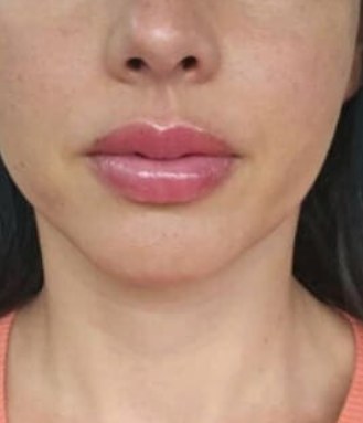 Jaw reduction, case 3 of 3: after