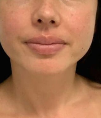 Jaw reduction, case 3 of 3: before