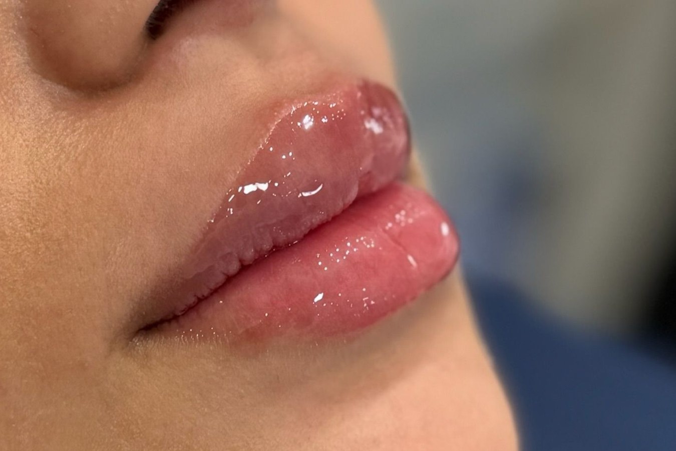 Lip correction, case 2 of 7: after