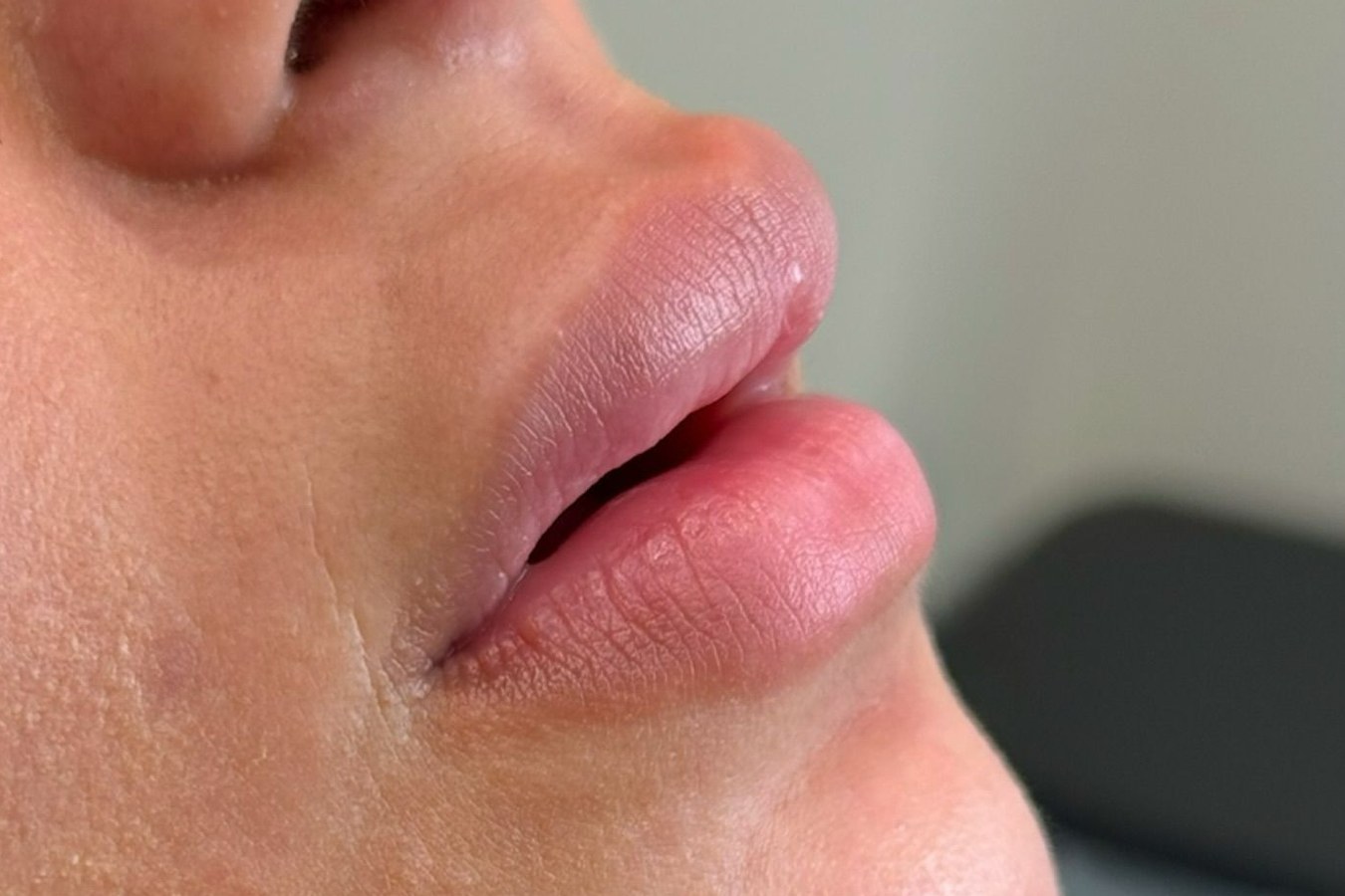 Lip correction, case 2 of 7: before