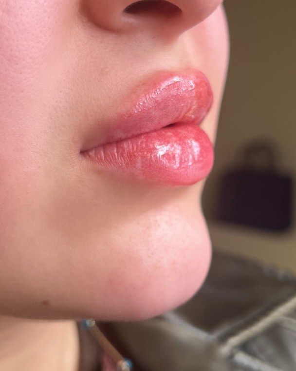 Lip correction, case 4 of 7: after