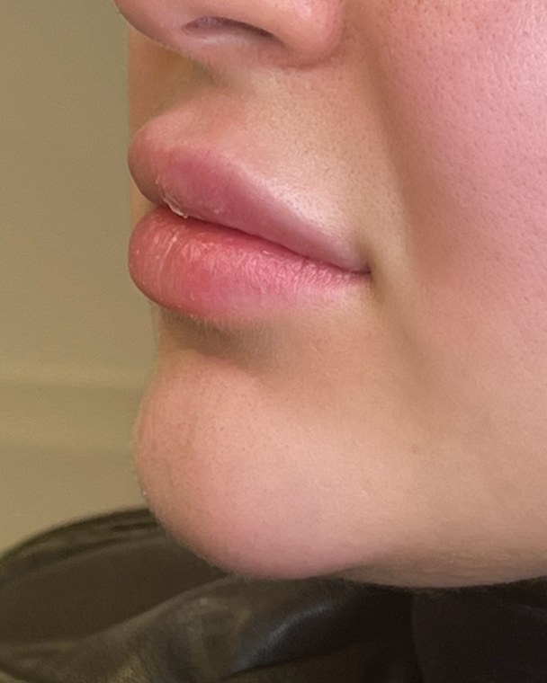 Lip correction, case 4 of 7: before