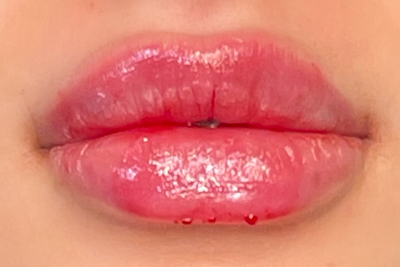Lip correction, case 5 of 7: after