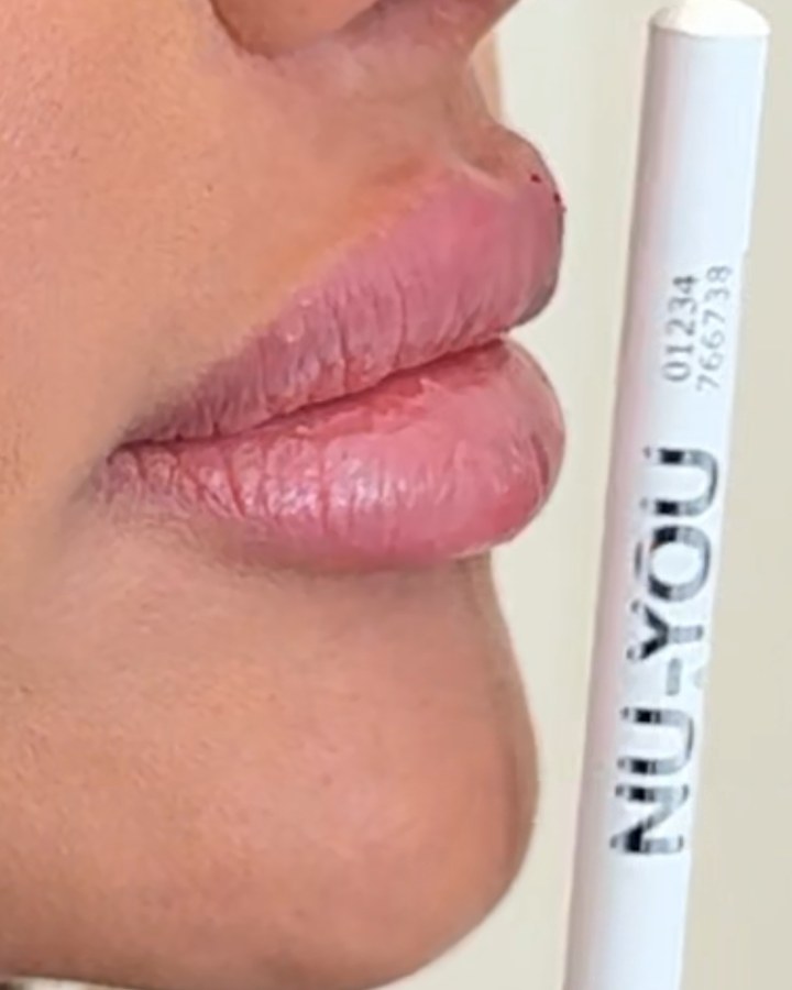 Lip correction, case 6 of 7: after
