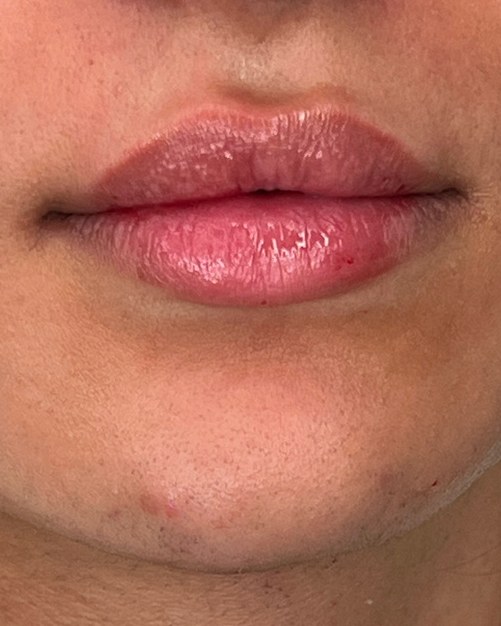 Lips, case 1 of 5: after