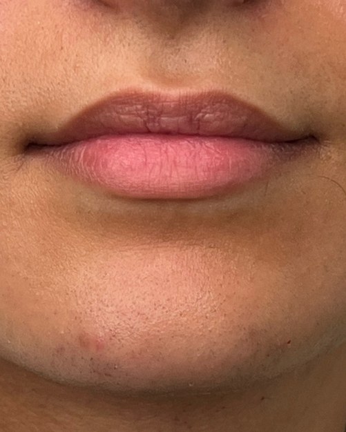 Lips, case 1 of 5: before