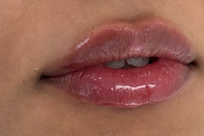 Lips, case 2 of 5: after