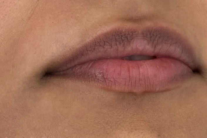 Lips, case 2 of 5: before