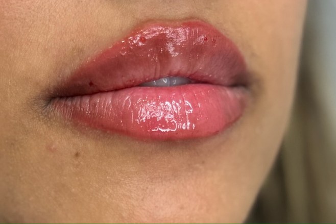 Lips, case 3 of 5: after