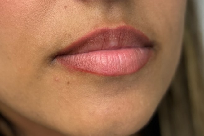 Lips, case 3 of 5: before