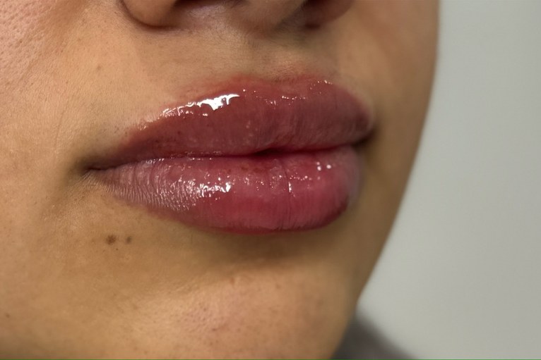 Lips, case 4 of 5: after