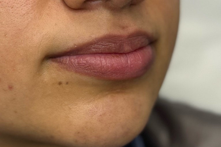 Lips, case 4 of 5: before