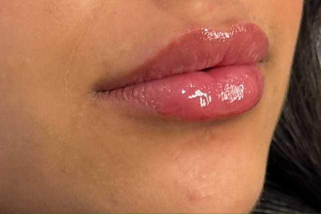 Lips, case 5 of 5: after