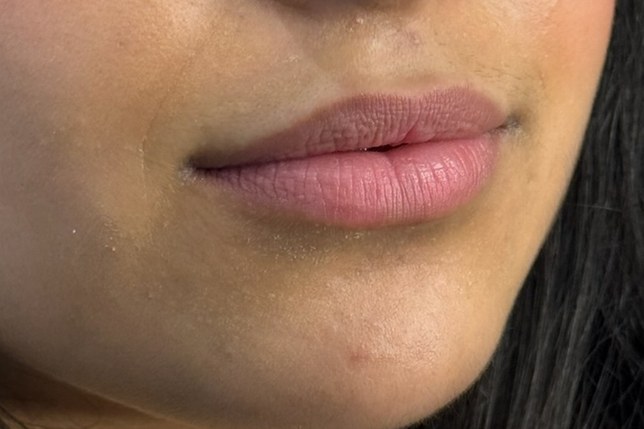 Lips, case 5 of 5: before