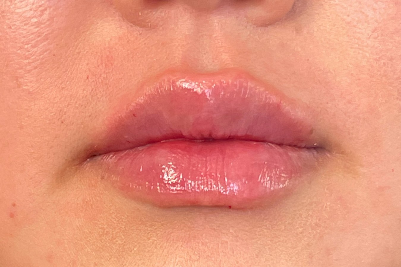 Lips, case 6 of 10: after