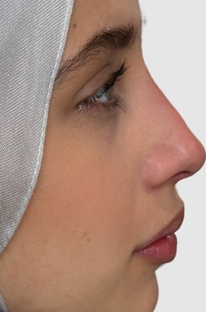 Nose, case 1 of 5: after
