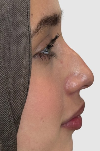 Nose, case 1 of 5: before