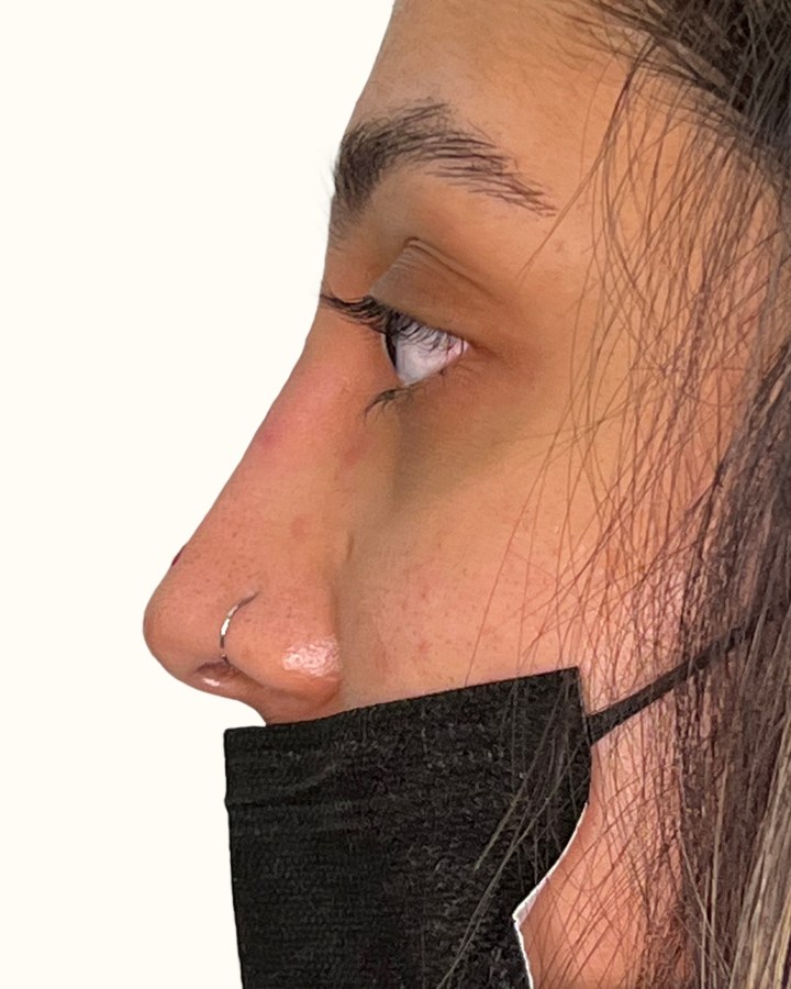 Nose, case 11 of 14: after