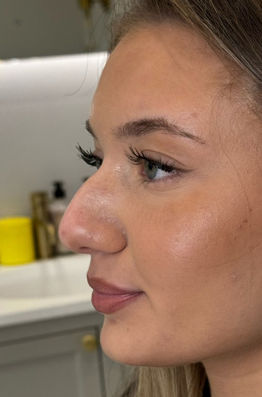 Nose, case 2 of 5: before