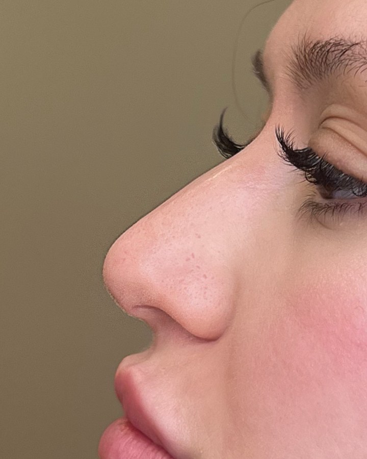 Nose, case 6 of 14: before