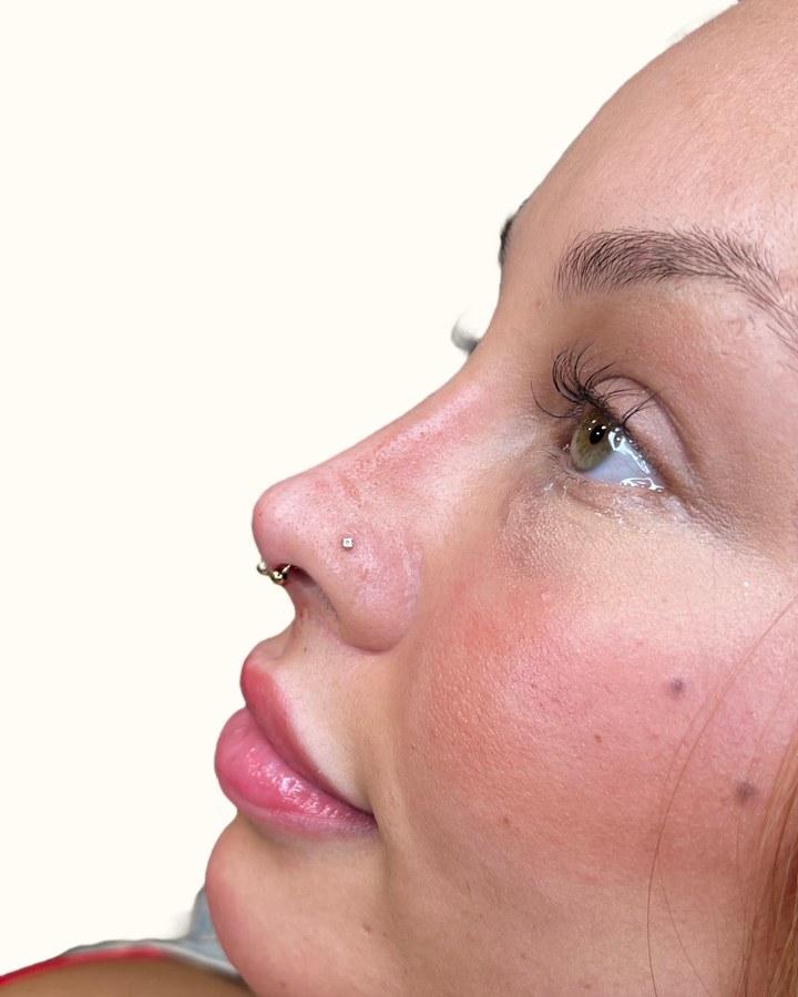 Nose, case 7 of 14: after