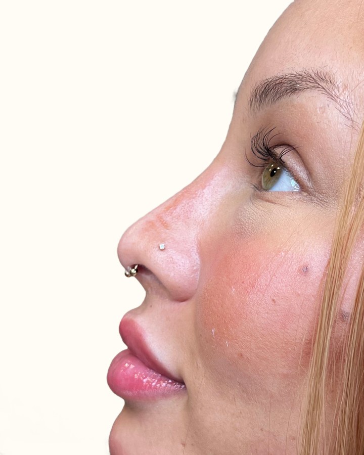 Nose, case 7 of 14: before
